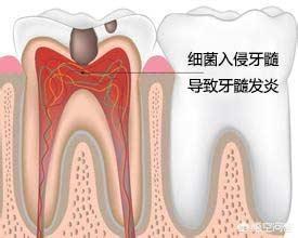门牙疼和松是怎么回事:最近门牙一摸就痛是怎么回事，怎么止痛？