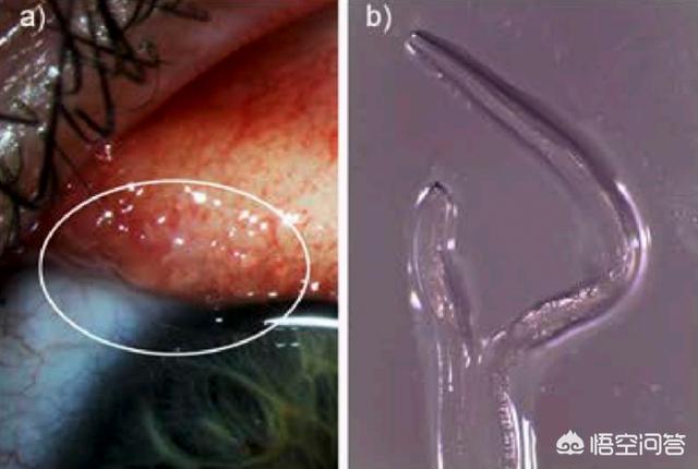 碑虫的图片:最离奇的寄生虫感染是什么样子的？