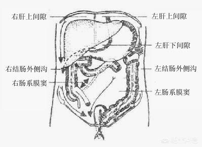 头条问答 腹水可以靠运动来减轻症状吗 6个回答