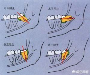 牙缝臭:牙缝里面软软发臭的黄泥，是什么，扣下来闻还很臭？