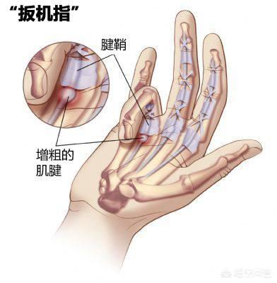 头条问答 得了腱鞘炎 如何缓解疼痛 小住院医的回答 0赞