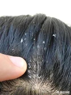 四岁多点的小孩有很多的头皮屑,是什么原因造成的？