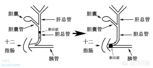 什么是胰腺炎;什么是胰腺炎疾病它的危害有多大