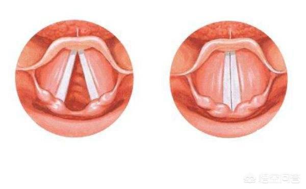 头条问答 - 声带麻痹会呼吸困难吗?(3个回答)