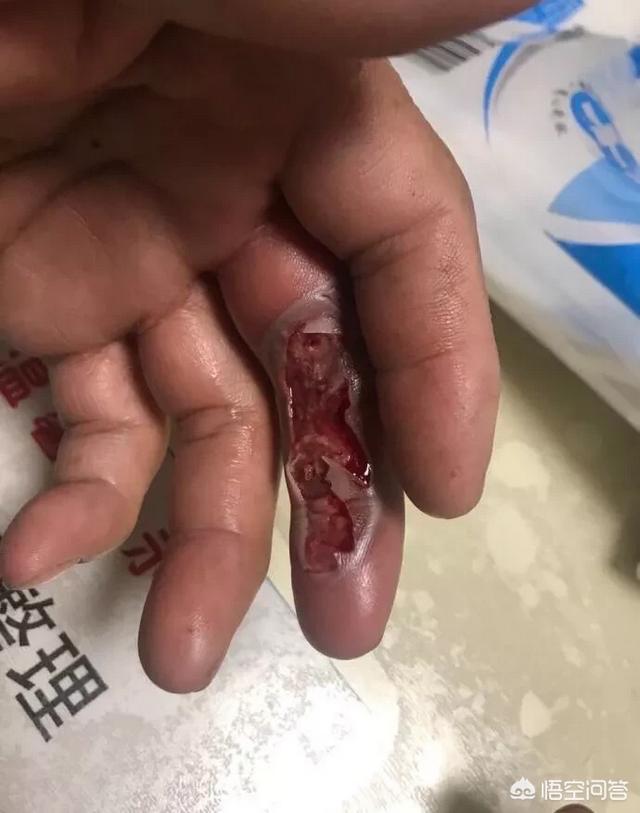 头条问答 - 金华浦江一环卫工人手被塑料瓶中倒出化学品强酸腐蚀,你