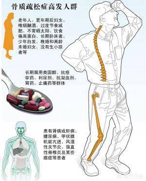 骨质疏松和缺钙的原因:女性绝经之后容易骨质疏松吗？