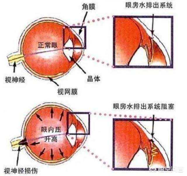 长时间在黑暗中看手机,会导致青光眼吗？