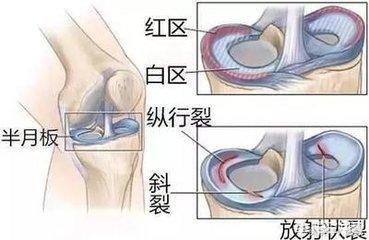 半月板撕裂:半月板撕裂后需要进行手术吗？