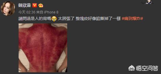 阿娇头部重伤:阿娇刮痧刮出一片血红，明星如此热衷的刮痧真的有用吗