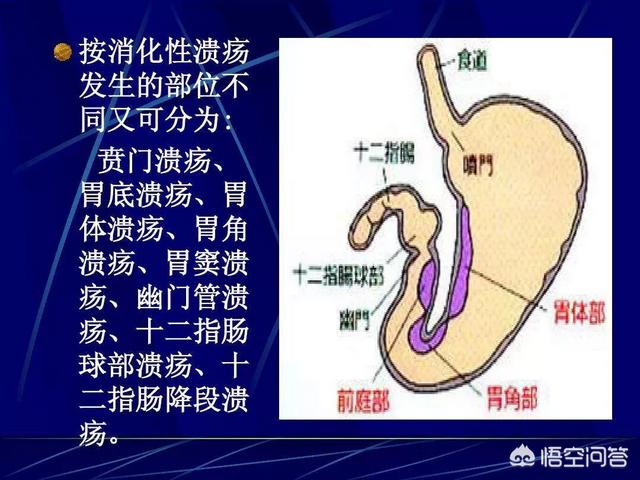 消化道溃疡:患有消化性溃疡，过年该怎么吃？