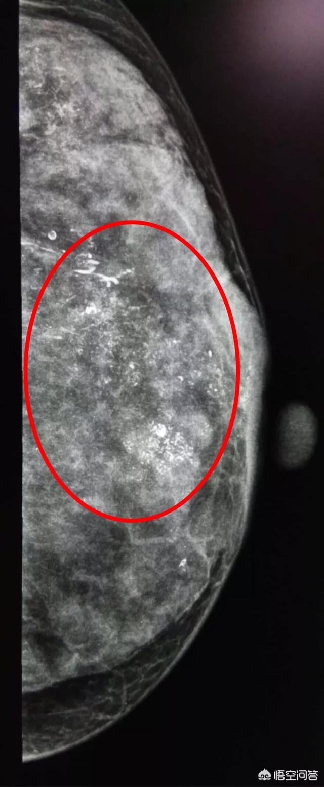 头条问答 乳腺肿块不一定是乳腺癌 可能是乳腺疾病 两者之间该如何区分 普外科曾医生的回答 0赞