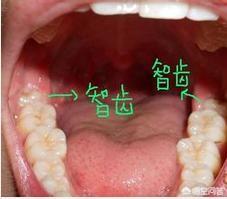 牙缝臭:牙缝里面软软发臭的黄泥，是什么，扣下来闻还很臭？