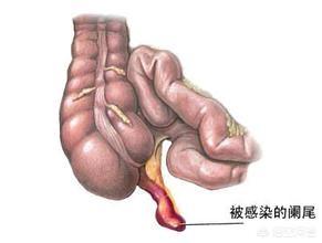 吴彦祖阑尾炎复发:吴彦祖再次患阑尾炎 已完全割除阑尾正在休养