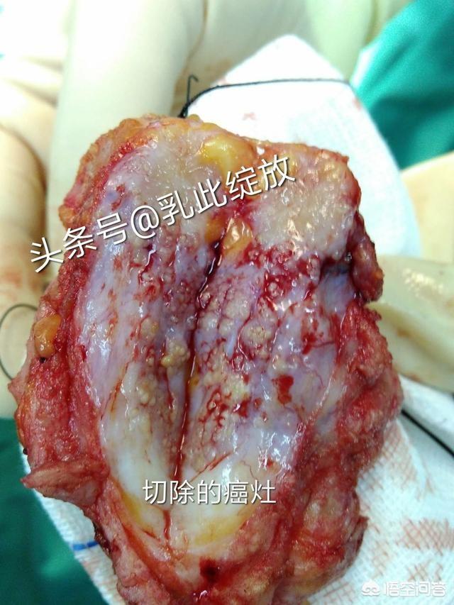 乳房蜂窝组织炎图片:胸痛是一个什么病，为什么现在去医院总能看到“胸痛患者优先”？