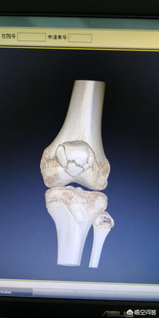 头条问答 - 膑骨骨折,拆了石膏后腿和脚为什么越来越肿呢?(11个回答)