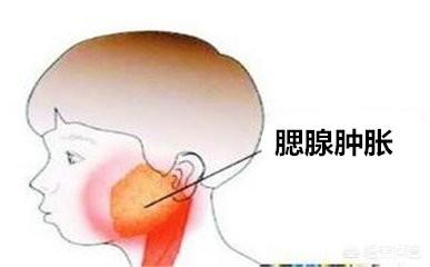 头条问答 - 又到了儿童腮腺炎的高发期,如何尽早发现与预防?(4个回答)