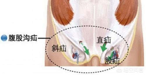疝气是怎么引起的？