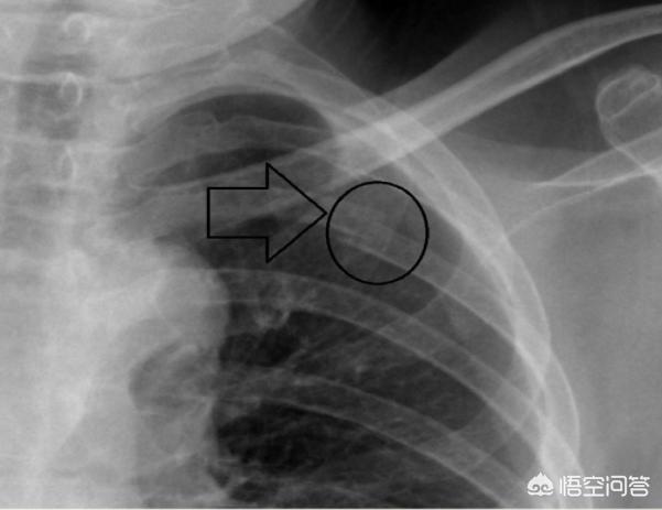 头条问答 右侧第七八根肋骨骨折怎么办 温州老年病医院李医生的回答 0赞