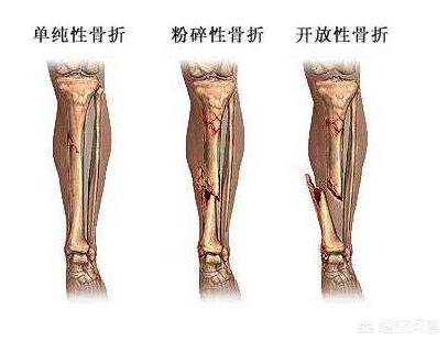 单纯腓骨骨折五十八天骨折部位酸肿:骨折后走路小腿肿疼怎么回事？