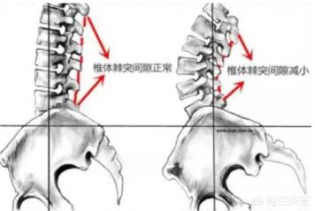 骨盆前倾是一种注意体态就可改变的状态吗？