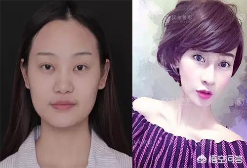 肋骨隆鼻后鼻尖发红痛:假体隆鼻之后鼻梁一直红，是怎么回事？