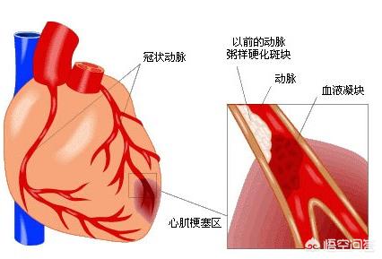心肌梗塞如何急救？