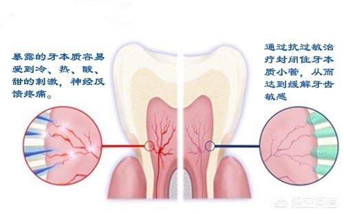 门牙疼和松是怎么回事:最近门牙一摸就痛是怎么回事，怎么止痛？