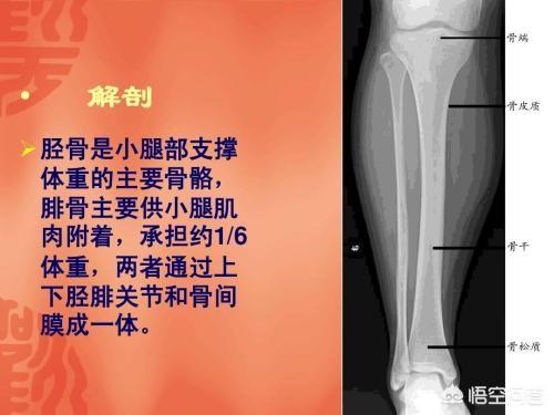 头条问答 胖子小腿骨折 术后应该怎么康复训练 3个回答