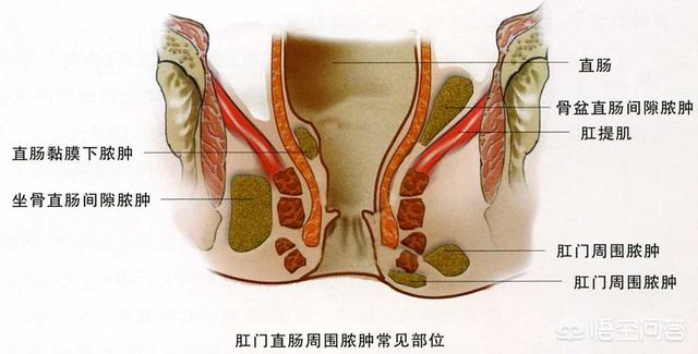 肛扩微信交流群二维码:肛周脓肿不严重可以不手术吗？