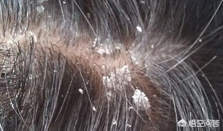 头屑头痒(头屑头痒掉发严重是什么问题?)