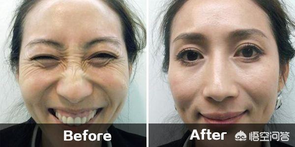 怎样去除皱纹,哪些方法可以去除皱纹呢？