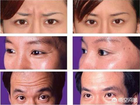 怎样去除皱纹,哪些方法可以去除皱纹呢？