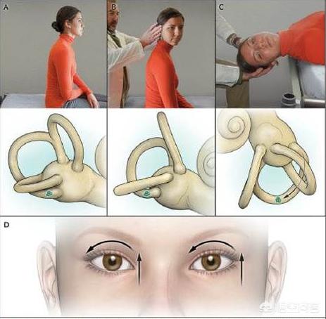 头条问答 - 前庭功能检查的dix-hallpike试验及冷热水试验是怎样的?