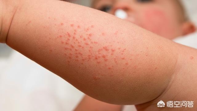 小儿痱子如何进行护理治疗