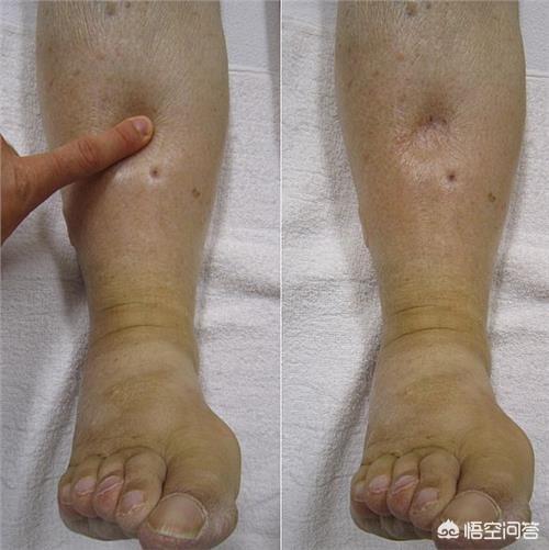 头条问答 - 太原一女子下午买鞋发现脚变大了,第二