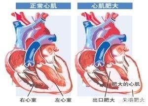 肥厚型心肌病心超分型:心尖肥厚型心肌病如何确诊 肥厚性心肌病3年了消融术也做过，现在又复发了，怎么办？