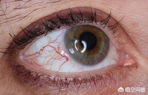 如何判断是慢性角膜炎:熬夜晚上休息不好的时候，眼睛里为什么会有血丝？