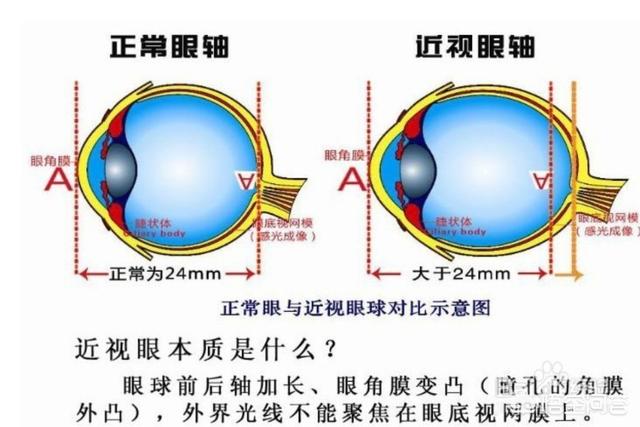 如何治疗假性近视(如何治疗假性近视眼)