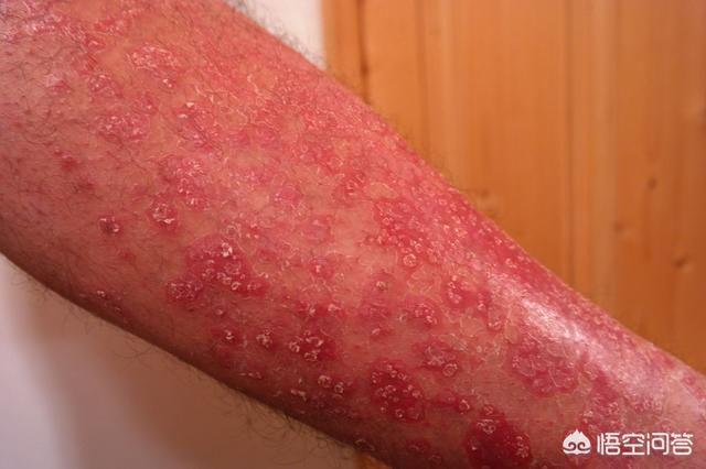 头条问答 - 贝赫切特病是怎么回事?(8个回答)