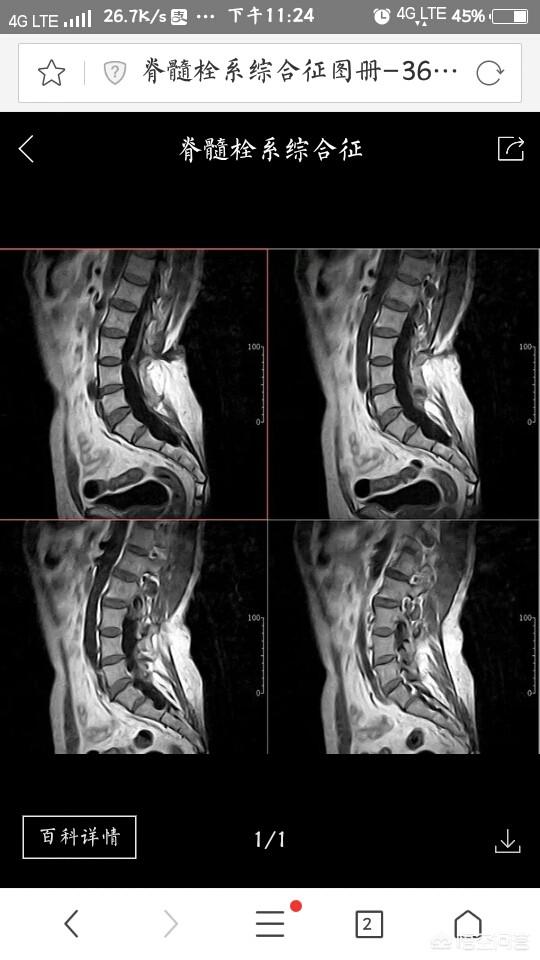 终丝增粗型脊髓栓系图片