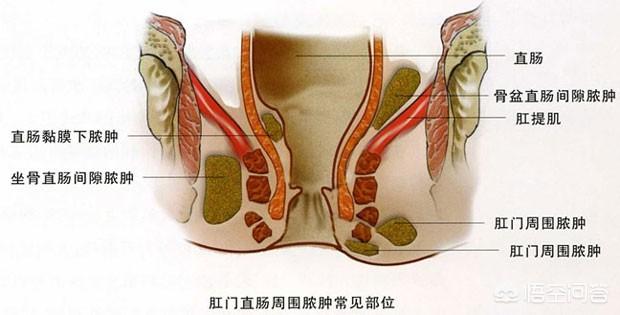 毒疖子和火疖子的区别,肛周脓肿和臀部疖肿有什么区别？