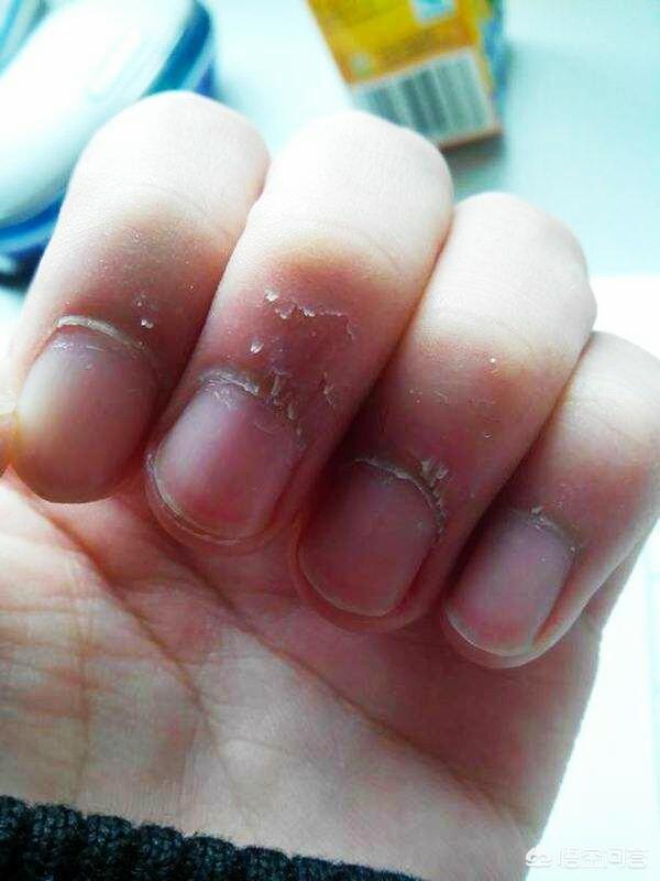 头条问答 - 孩子手指尖出倒刺该怎样处理?(13个回答)