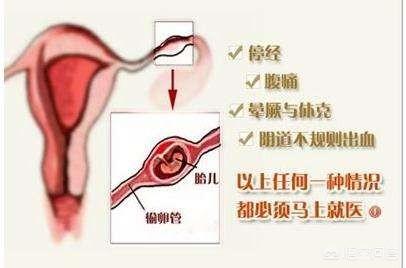 宫外孕是什么：造成宫外孕的原因是什么？切除输卵管之后对身体有什么伤害？