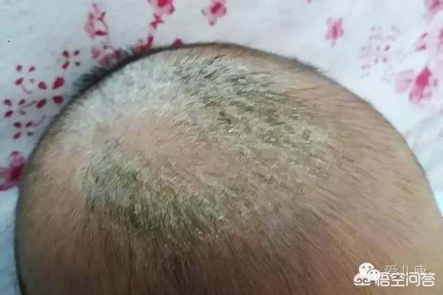 头条问答 - 四个月的婴儿头上有头垢该怎么办?(家常吃货的回答,0赞)