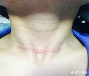 术后皮下硬结:甲状腺乳头癌术后切口为什么会有硬块？
