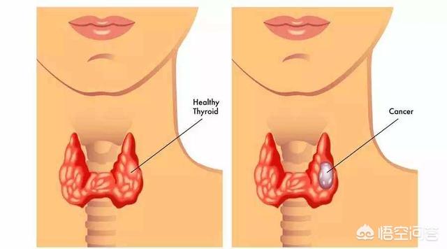 甲状腺结茄-胸痛与甲状腺有关系吗