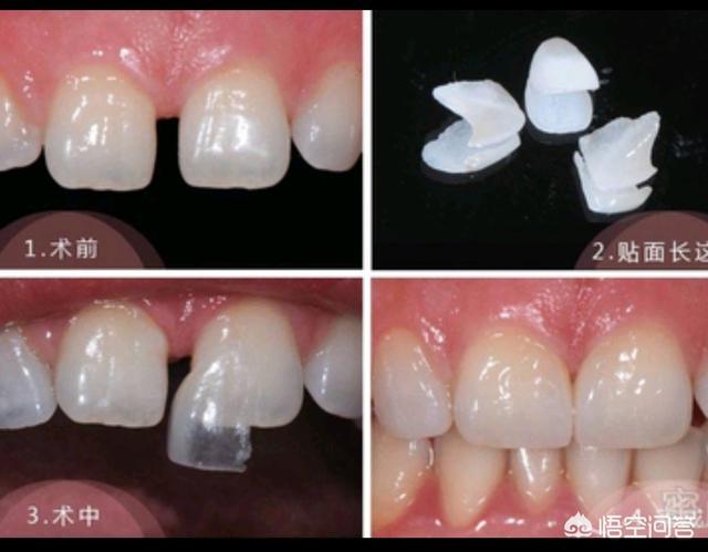 头条问答 - 牙齿缝隙大怎么办?(35个回答)