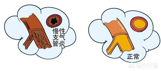 肺炎会传染吗:朋友的孩子得了肺炎，朋友会传染给别人吗？