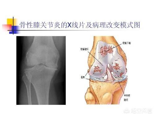 劳损性关节炎能治好吗:45岁得了骨关节炎，该怎样锻炼？ 劳损性关节炎能根治好吗