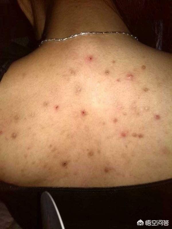 但是如果前胸后背身体有痤疮(背后长痘痘有很多种可能,有可能是捂出来